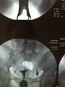 双腔取卵针和单腔取卵针有什么不同？